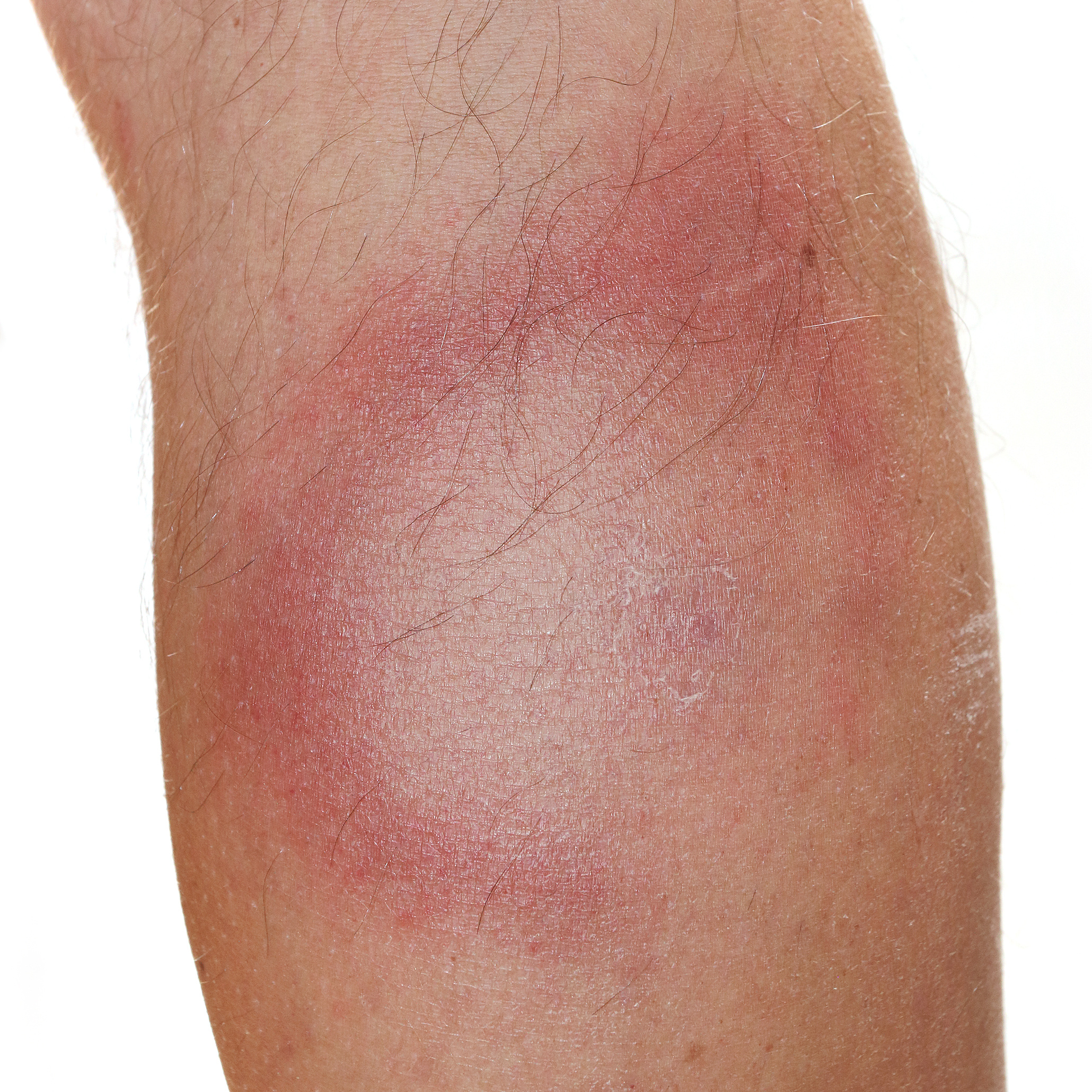 A red rash on a person's knee