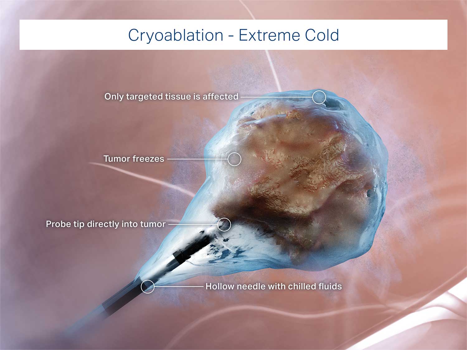 Cryoblation on a tumor