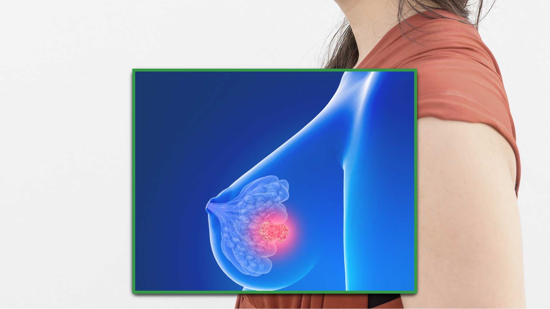 Case Study: Stage IV Breast Cancer Treatment With Metastatic Spread to the Bones
