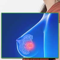Case Study: Stage IV Breast Cancer Treatment