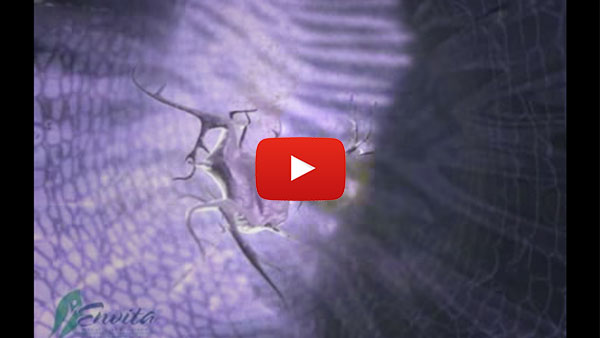 How Lyme Disease Works - Learn About Infections and Other Factors