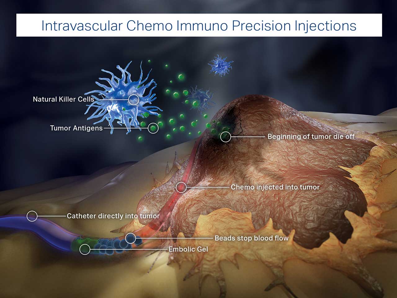 Graphic depicting Envita's Intravascular Chemo Immuno Precision Injections