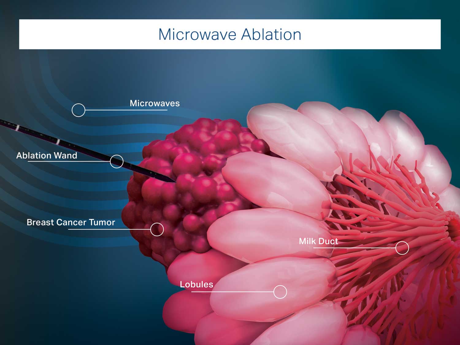 Microwave Ablation