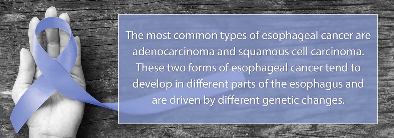 The most common types of esophageal cancer