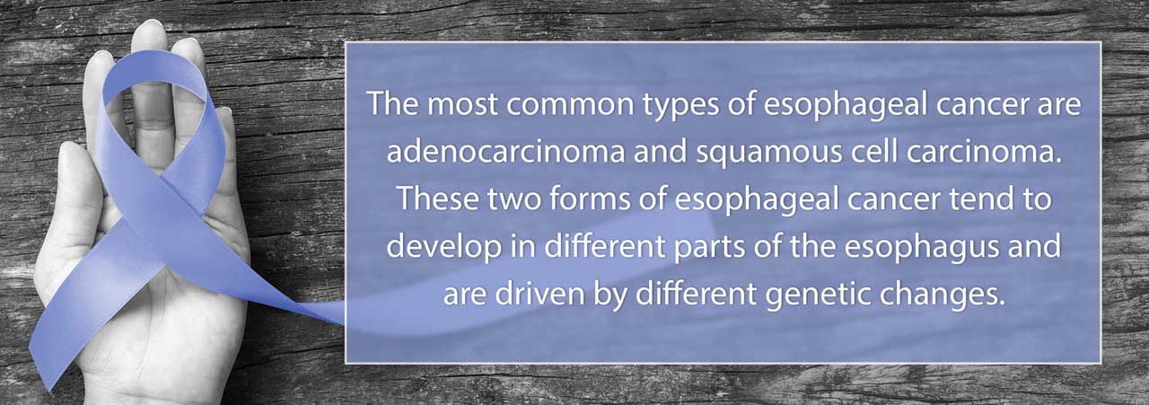 The most common types of esophageal cancer