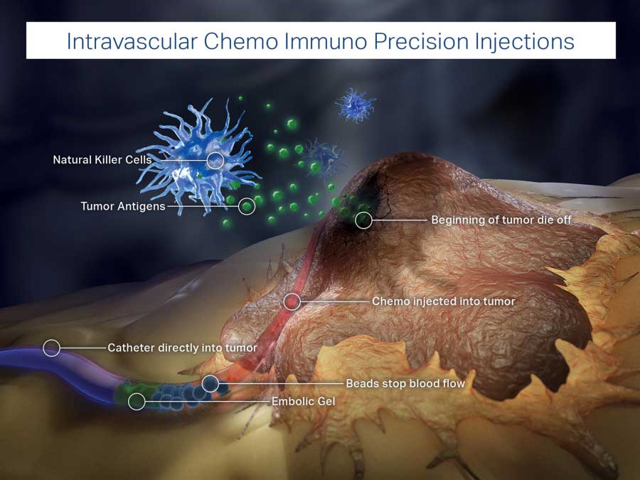 Cryoblation on a tumor