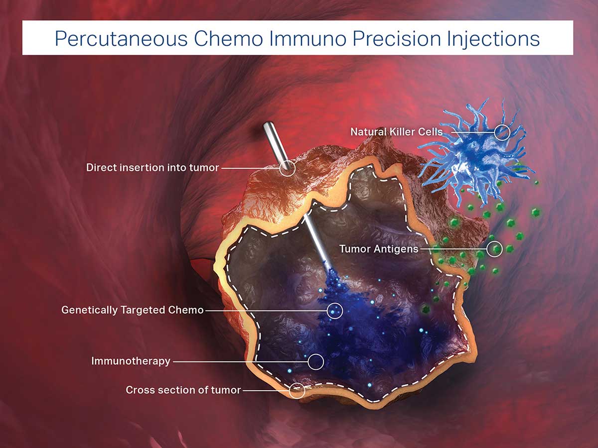 Chemo Immuno Precision Injections (CIPI™)