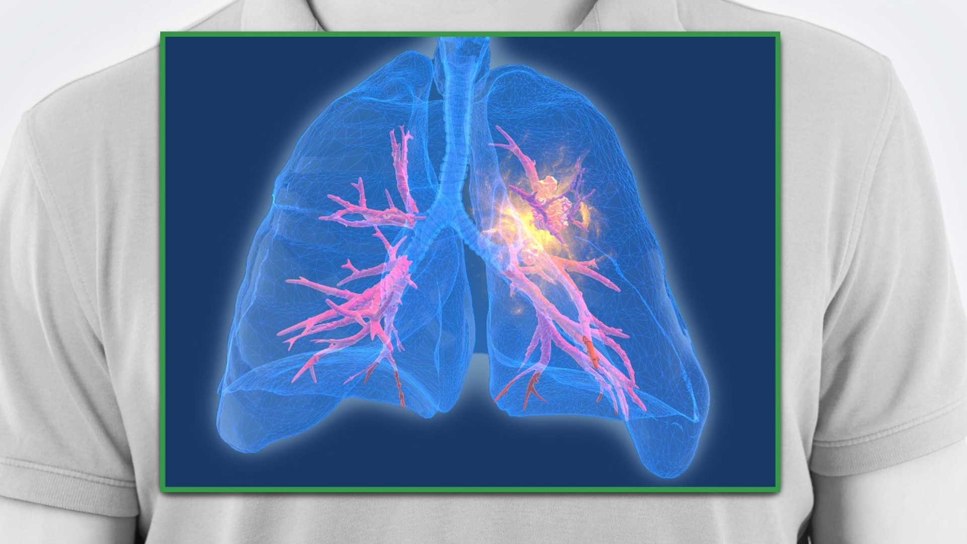 Case Study: Non-Small Cell Lung Cancer (NSCLC) Treatment