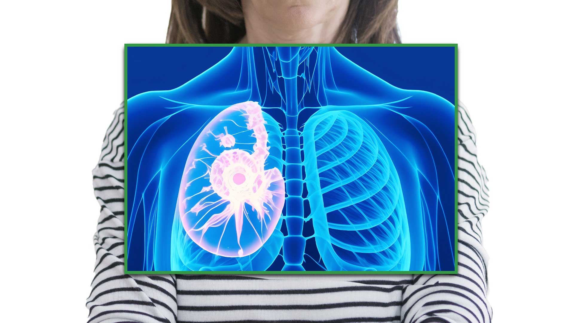Case Study Stage IV Breast Cancer Treatment With Metastatic Spread To 