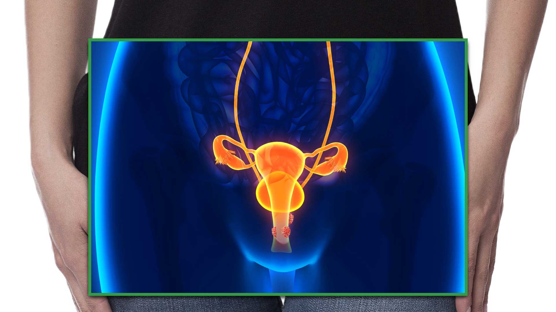 Case Study: Stage IV Cervical Cancer Treatment