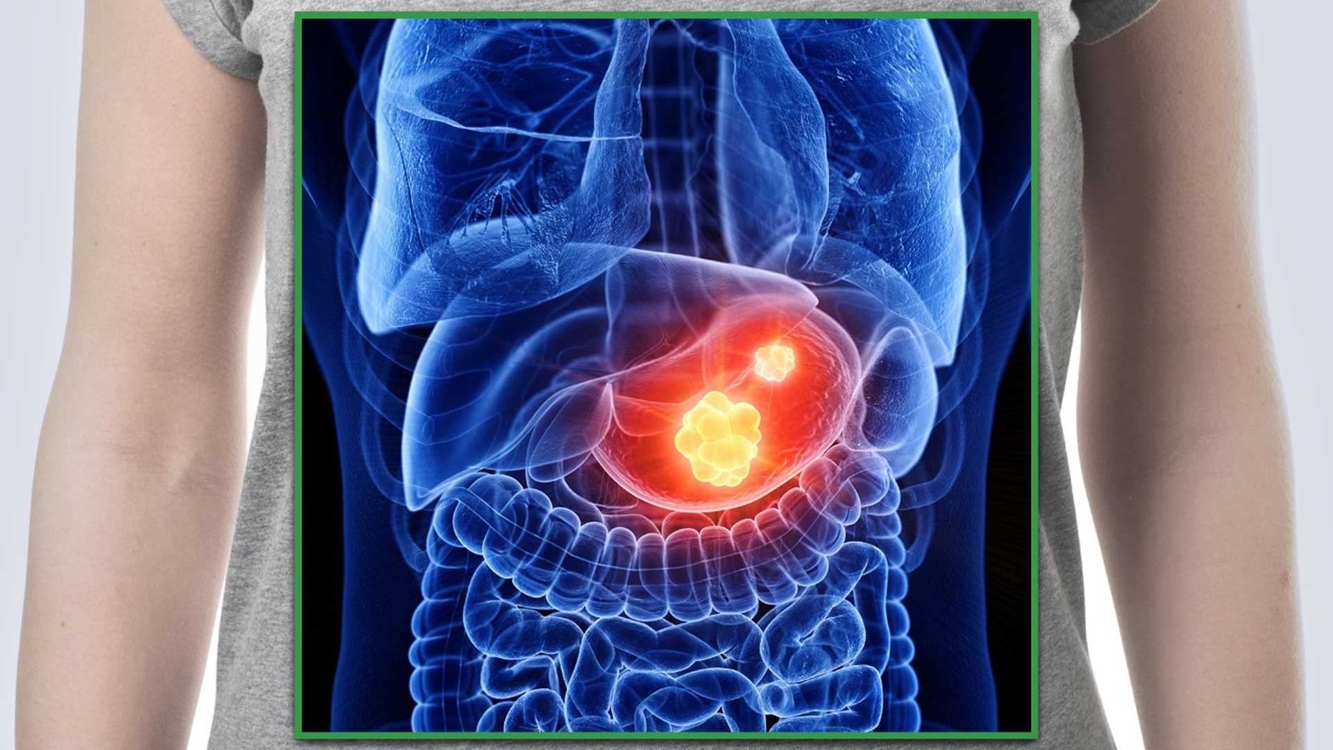 Case Study: Stage IV Gastrointestinal Stromal Tumor (GIST) Cancer Treatment