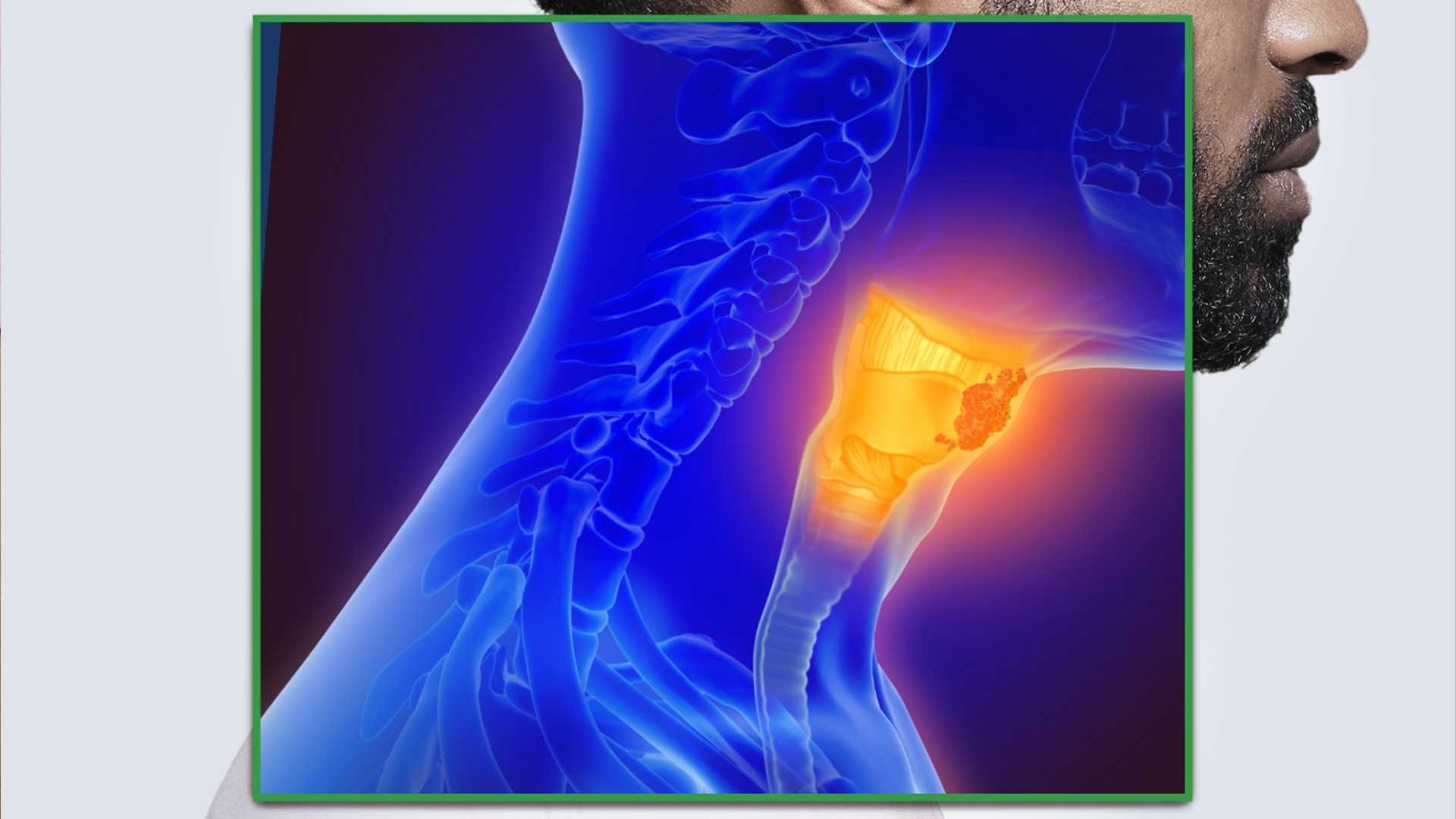 Case Study: Stage IV Head and Neck Squamous Cell Carcinoma Cancer Treatment