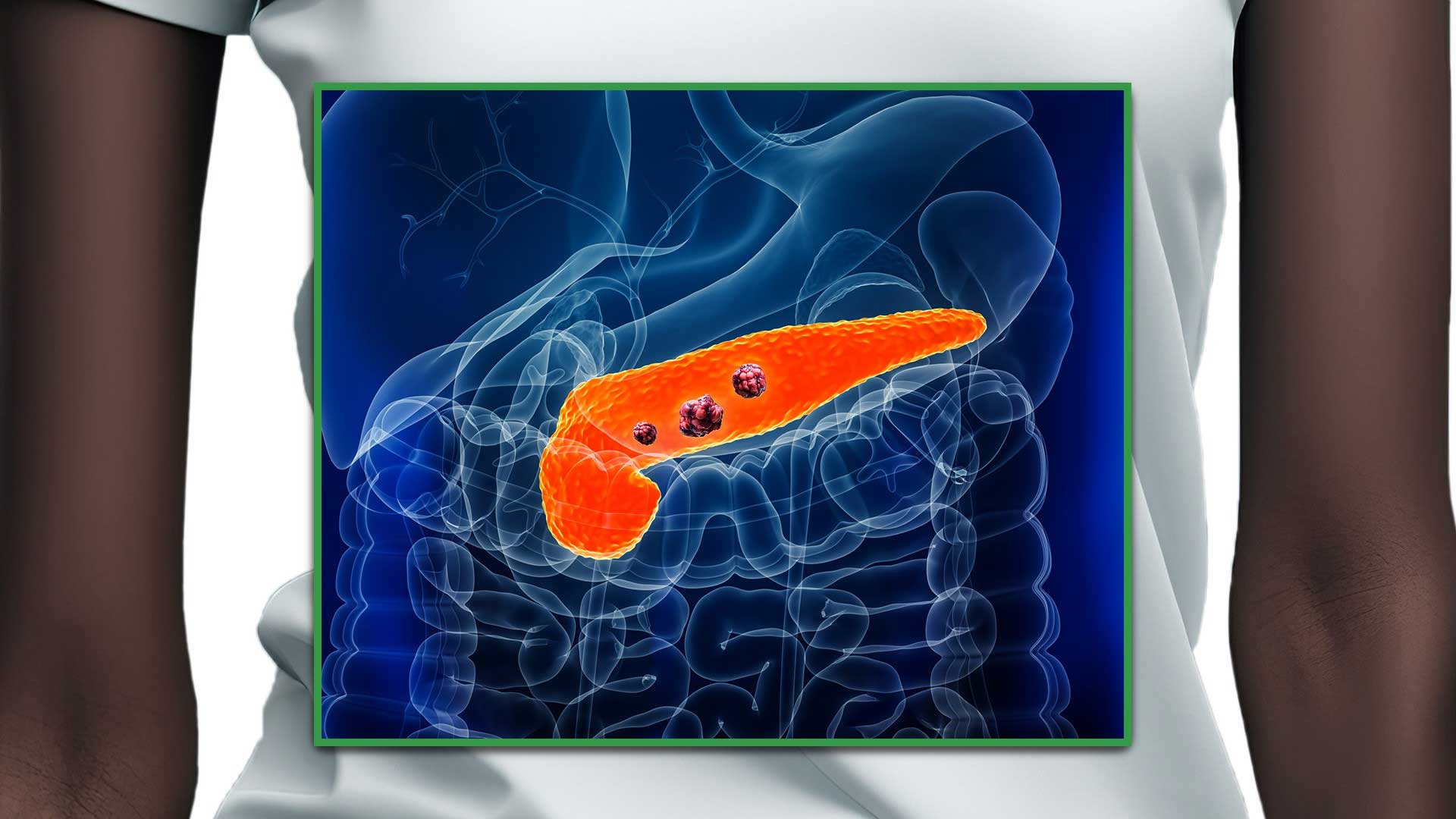 Case Study: Stage IV Precision Pancreatic Adenocarcinoma Cancer Treatment