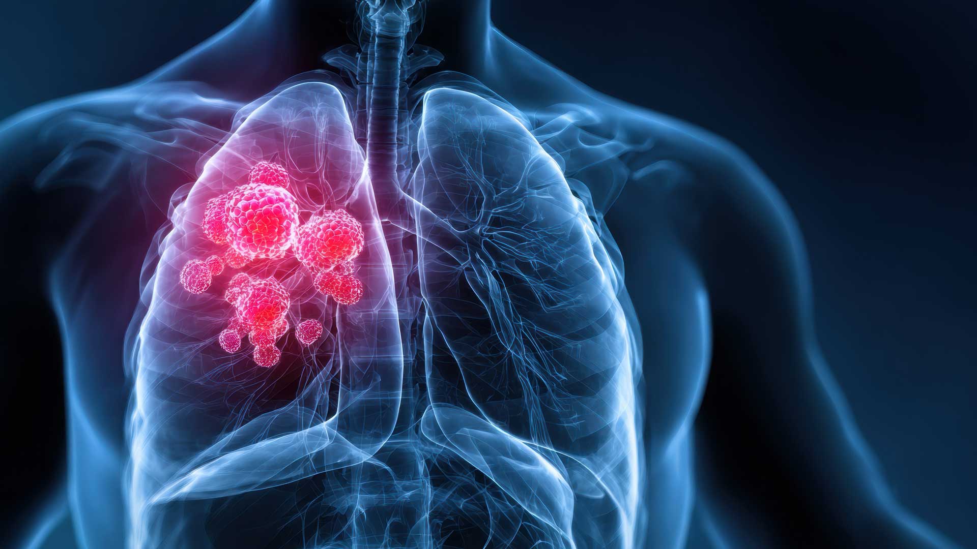 Dr. John Oertle Highlights Precision Lung Cancer Approaches on AZ Family