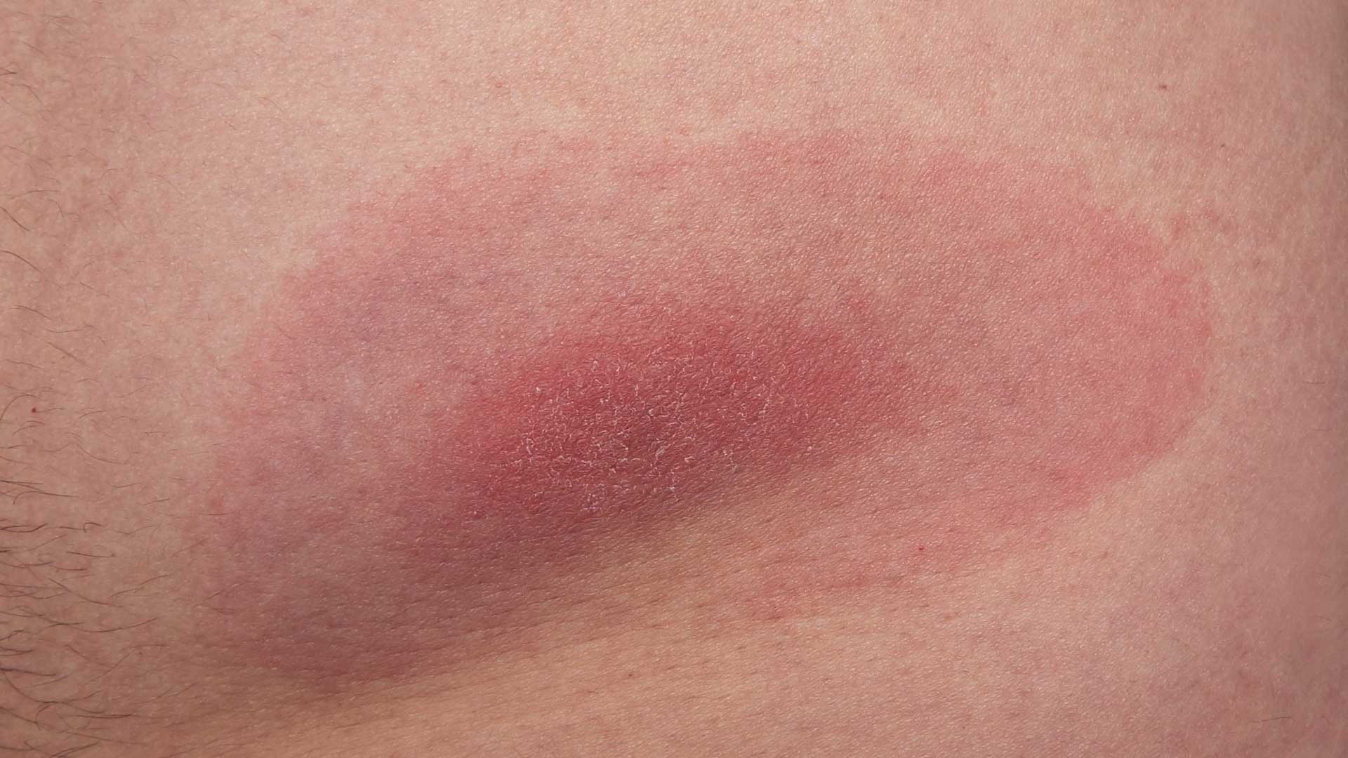 Former Patient and Current Patient Care Educator at Envita Discusses Lyme Disease on AZ Central