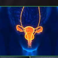 Case Study: Stage IV Cervical Cancer Treatment