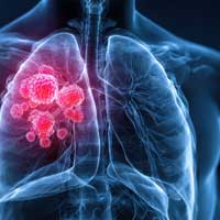 Dr. John Oertle Highlights Precision Lung Cancer Approaches on AZ Family